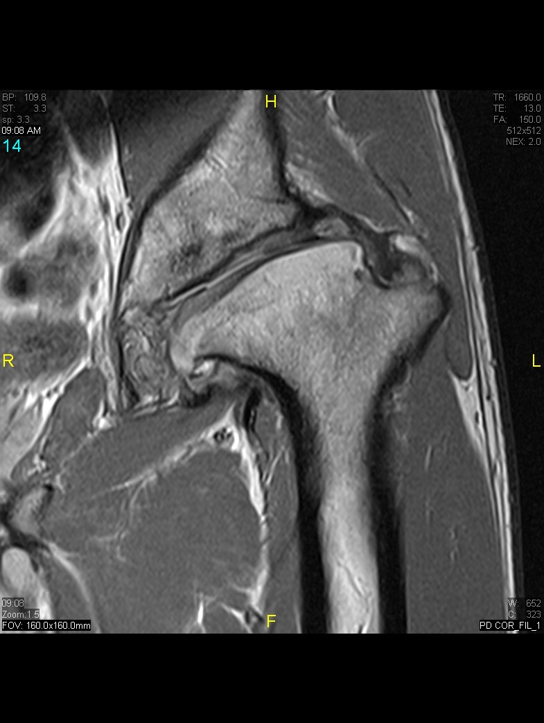 Figure 6 for case History Perthes Disease